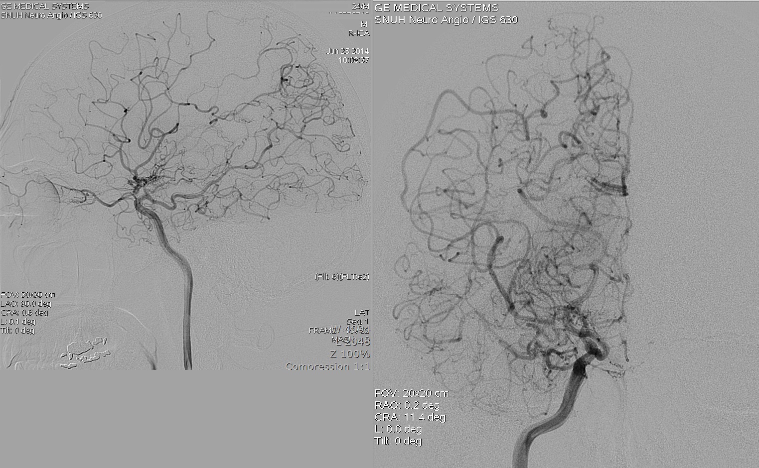 Published right internal carotid angiography in frontal and lateral projections